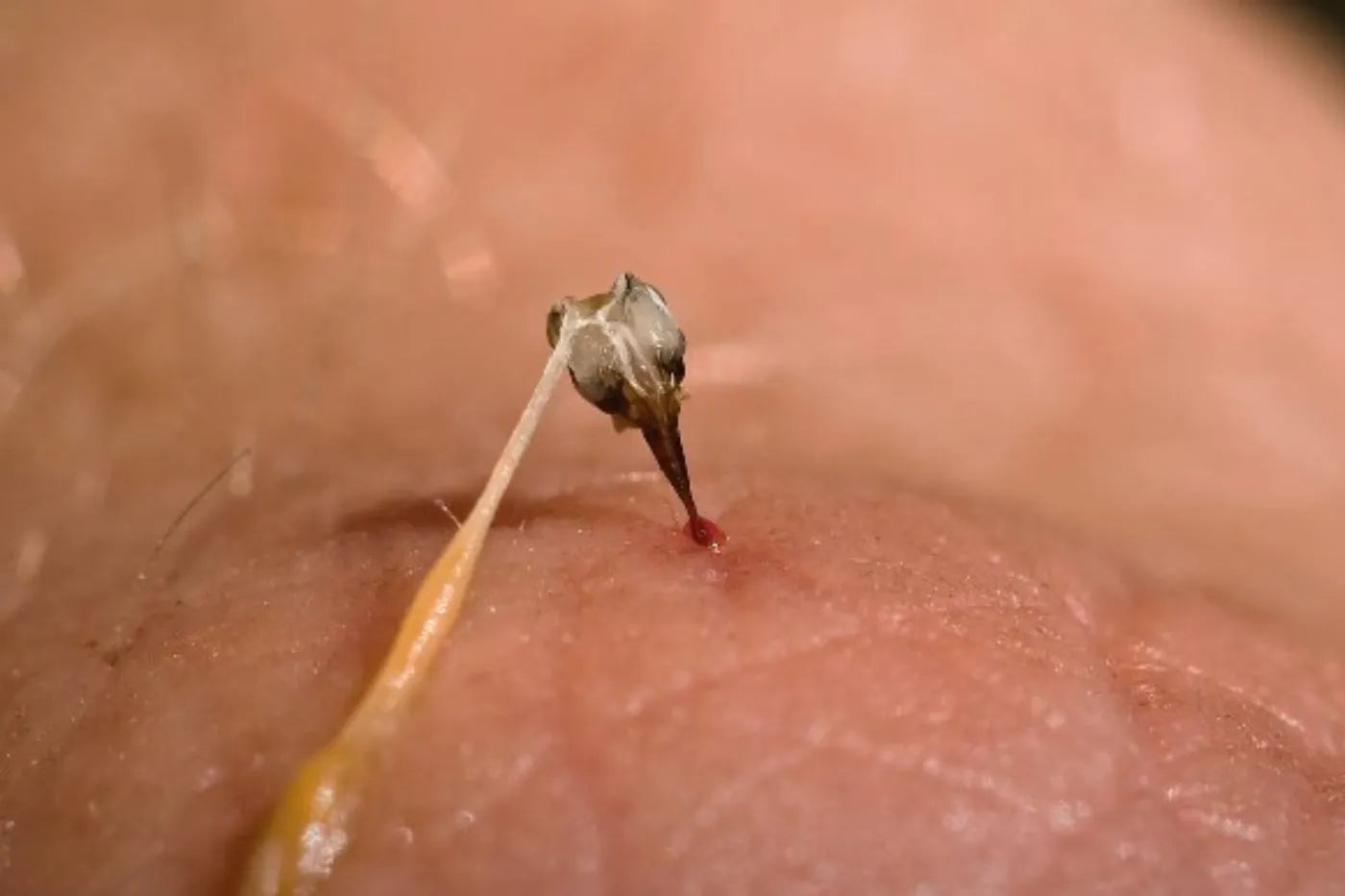 Removing a Bee Stinger